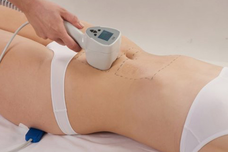 RF лифтинг тела, коррекция жировых отложений тела.